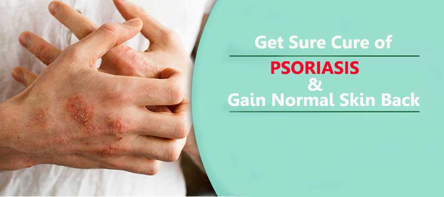Psoriasis – Causes, Symptoms, and Types - Nature & Cure